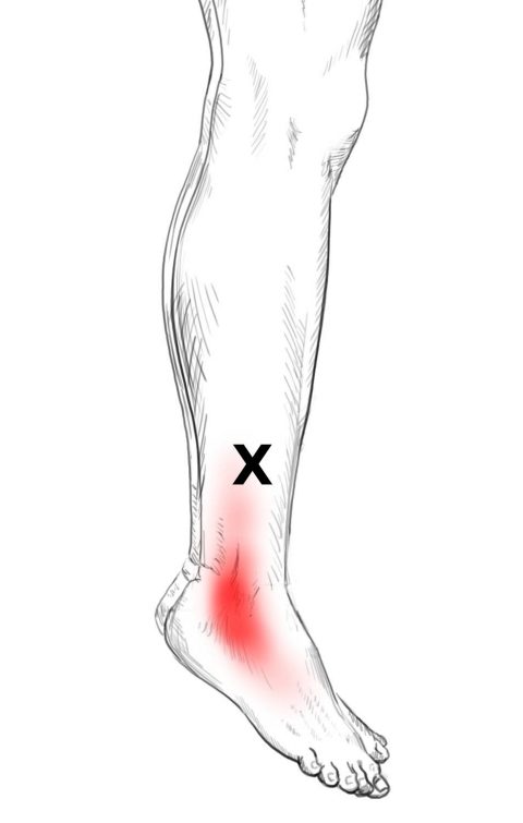 Peroneus Longus Muscle Pain