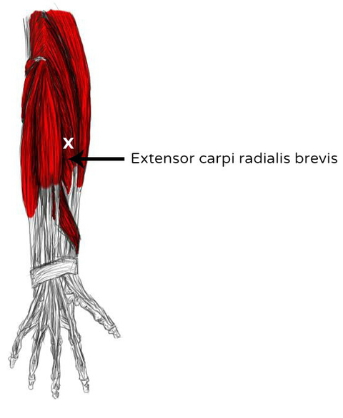 M brachioradialis. Мускулюс брахиорадиалис. Radialis Longus. Extensor Carpi radialis Longus мышца. Brachioradialis мышца.