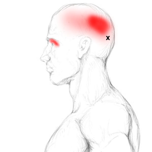 Frontalis and Occipitalis – Pain & Trigger Points