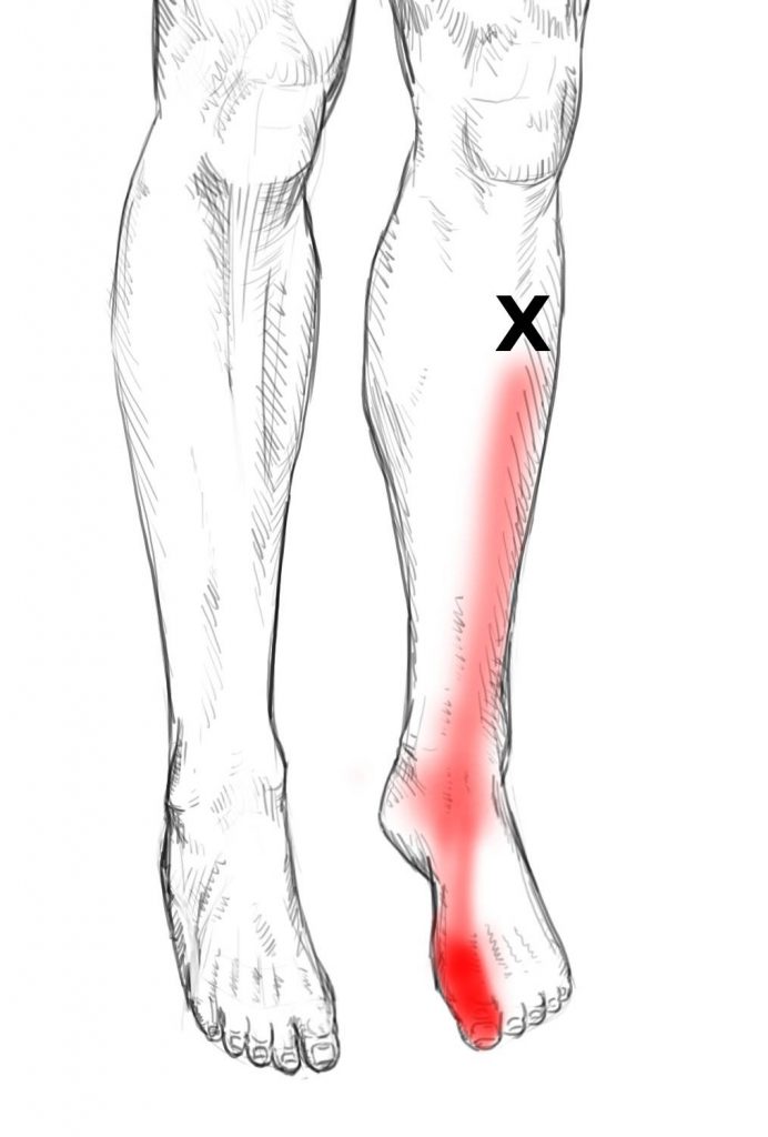 Tibialis Anterior – Pain & Trigger Points