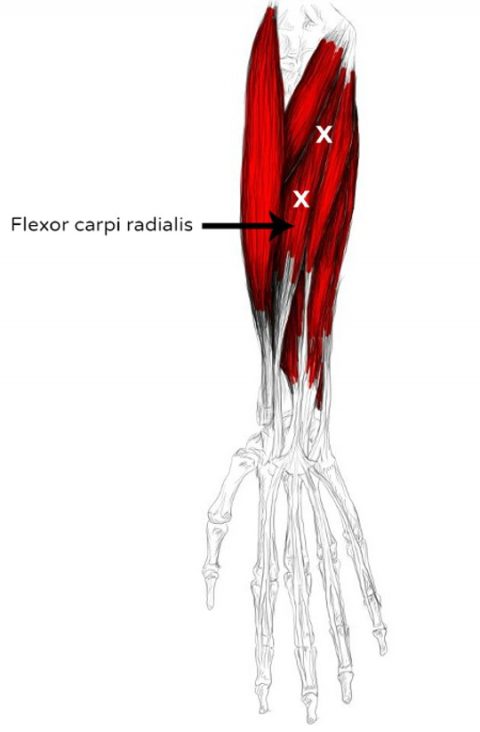 Flexor Carpi Radialis Tendinopathy