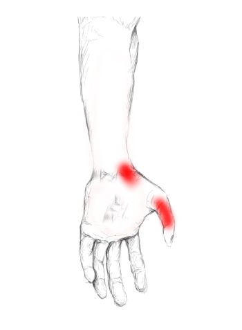 Opponens Pollicis – Pain & Trigger Points