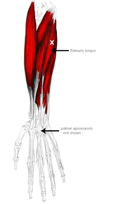 Palmaris longus muscle pain & trigger points