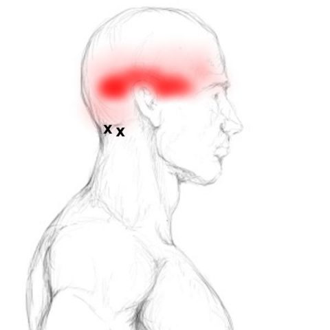 The Ultimate Guide to the Suboccipital Muscles