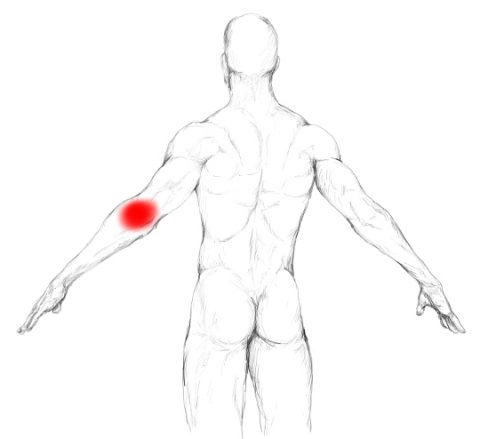 Triceps brachii muscle pain & trigger points