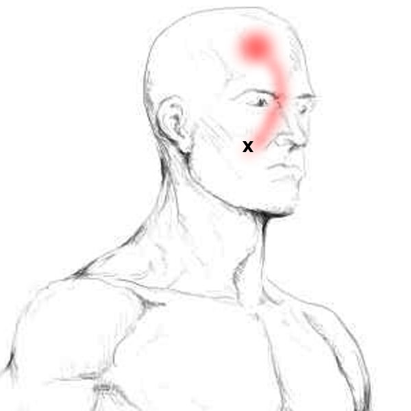 Zygomaticus Major – Pain & Trigger Points